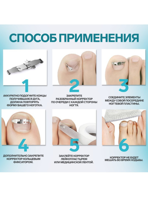 Корректор-фиксатор для вросшего ногтя, размер M, в пластиковом футляре, цвет серебристый